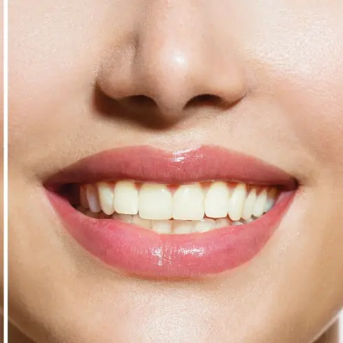 Before and After Teeth Whitening
